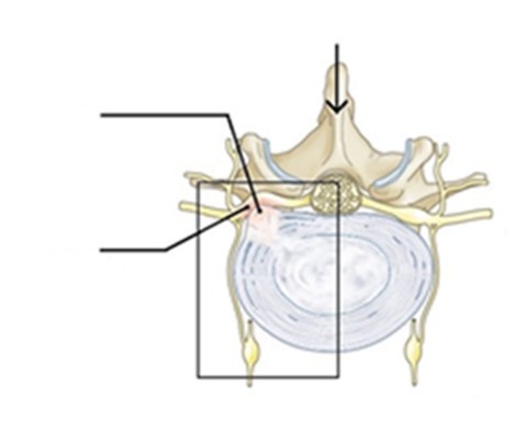 Transforaminale epidurale infiltratie 